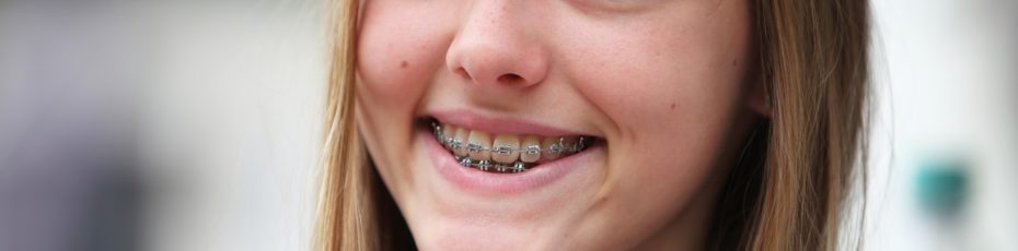 how to take care of your braces and retainers