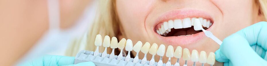 must know facts about teeth whitening