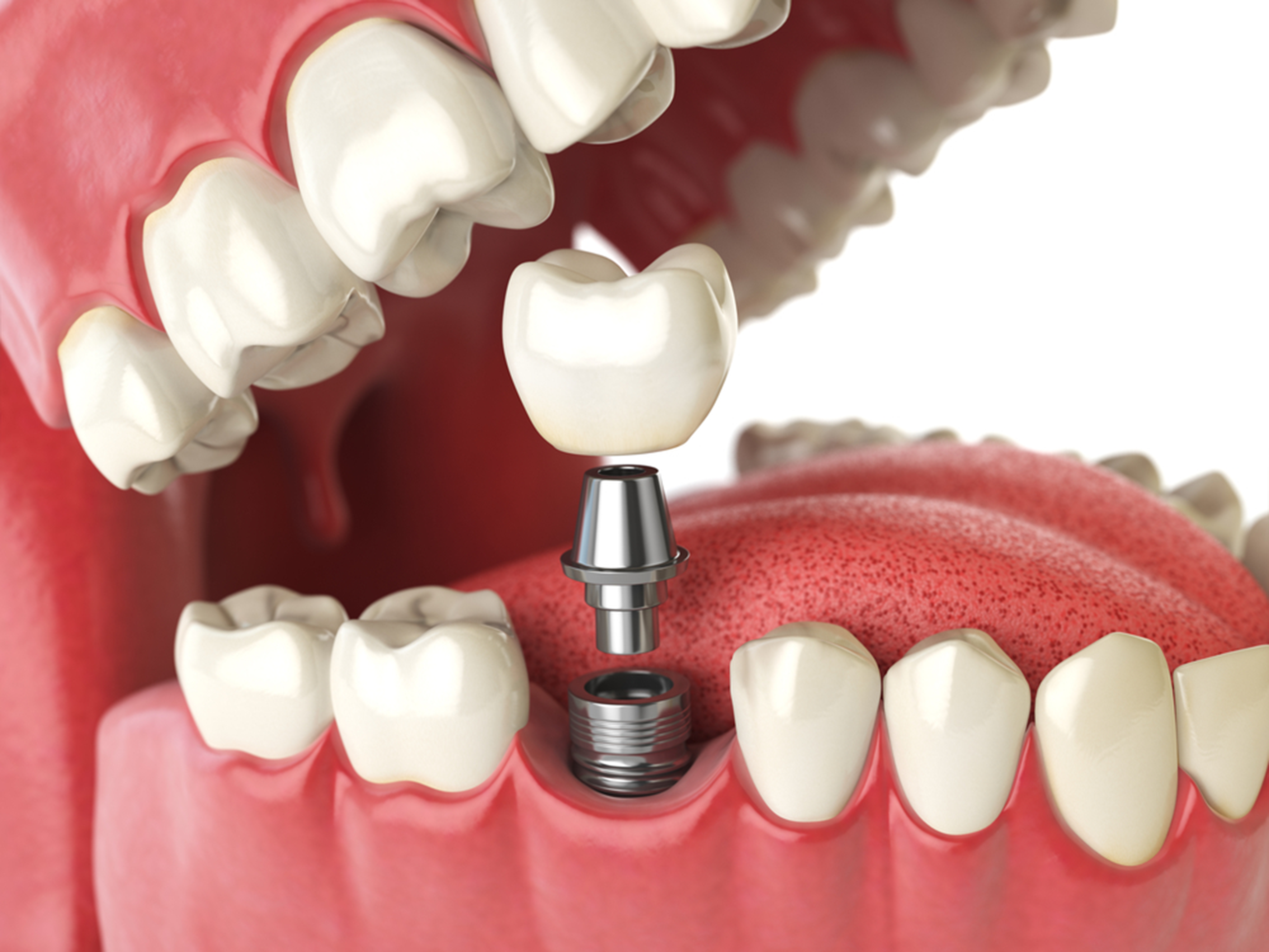 5 facts of dental implants