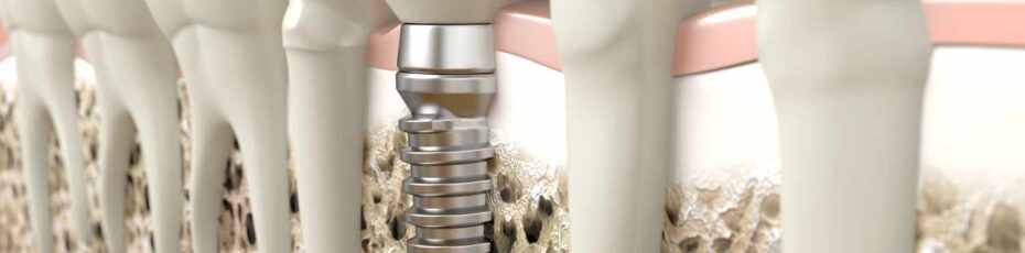 when to consider dental implants