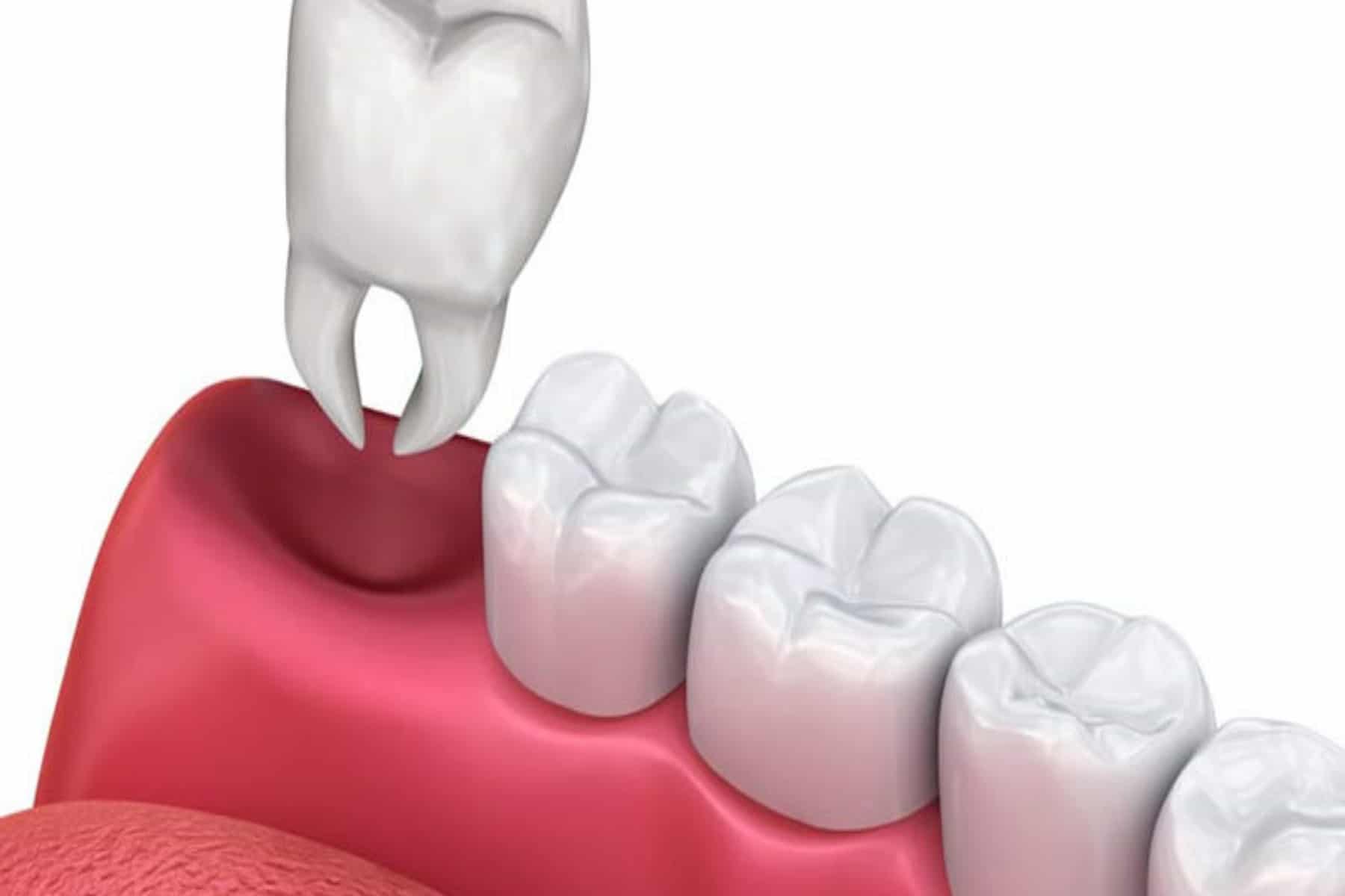 What is an open bite? What is an overbite? Can you have both at the same  time? - Quora