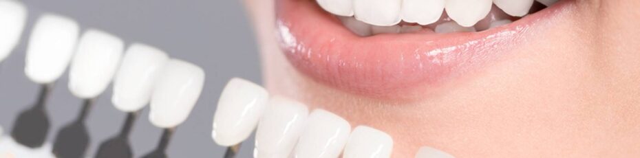 porcelain or composite veneers which is best