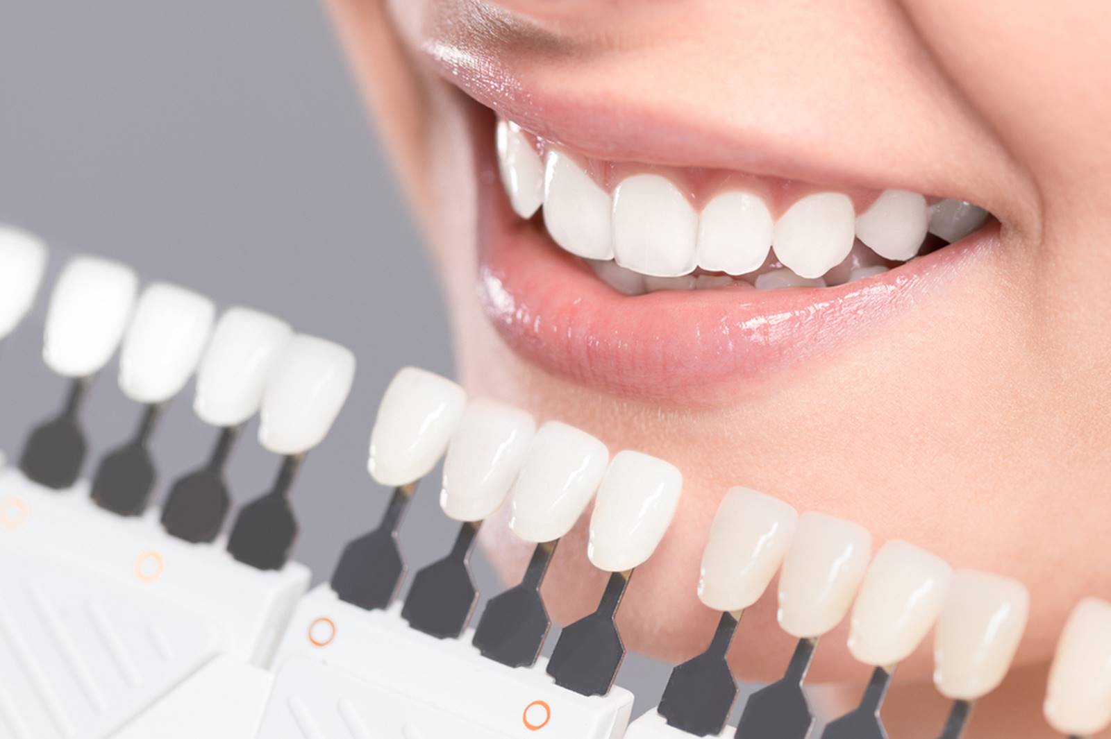 porcelain or composite veneers which is best