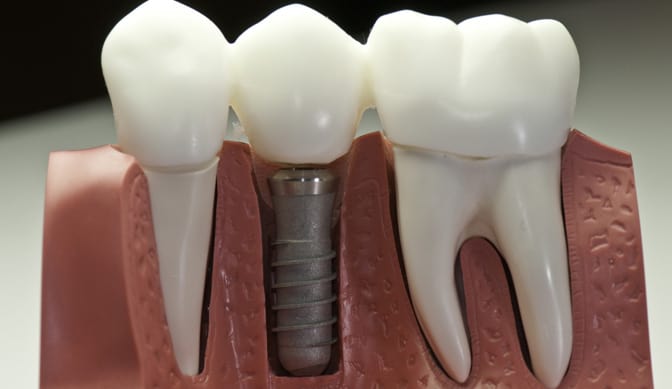 dental implants in brandon