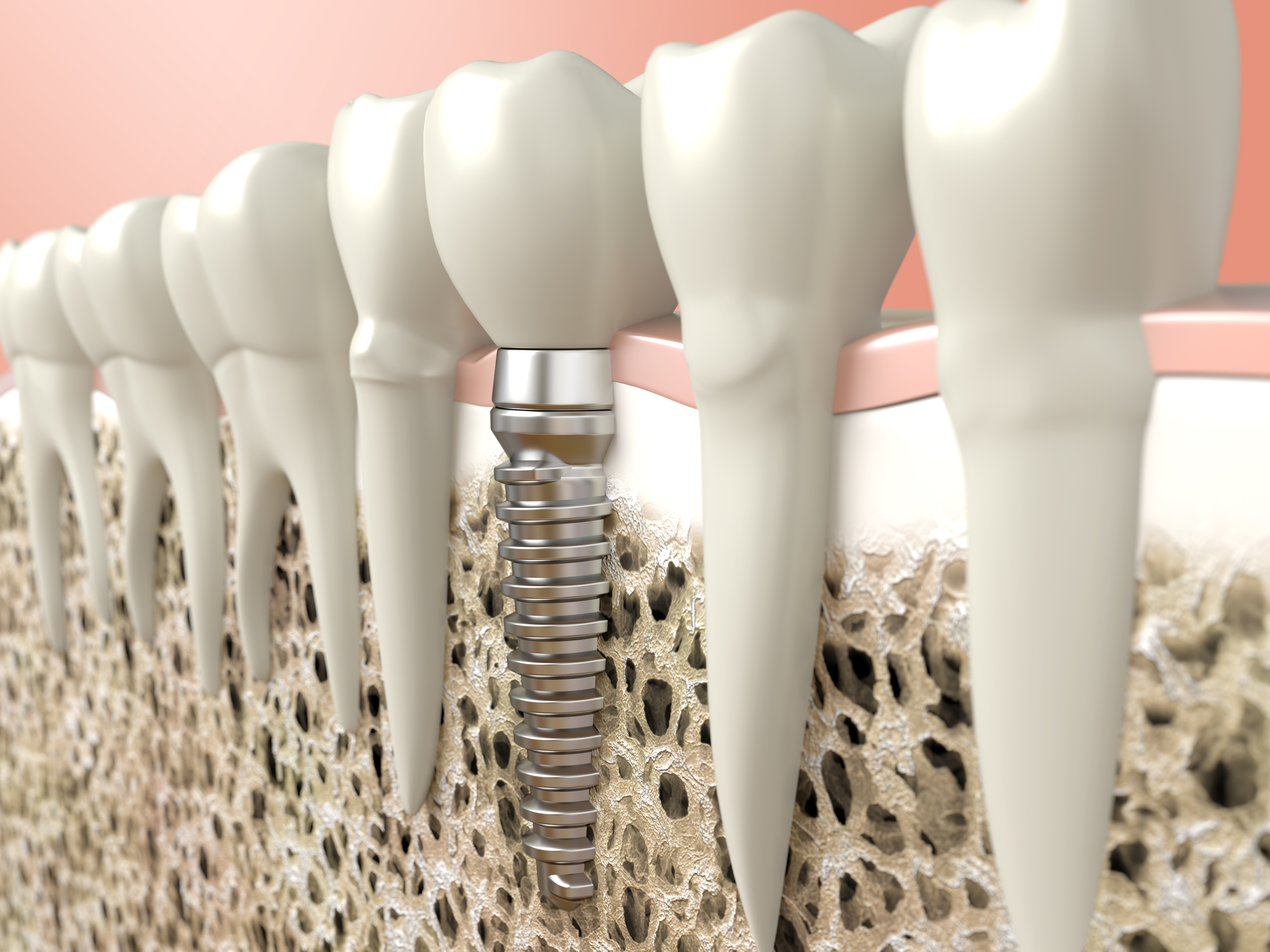 when to consider dental implants