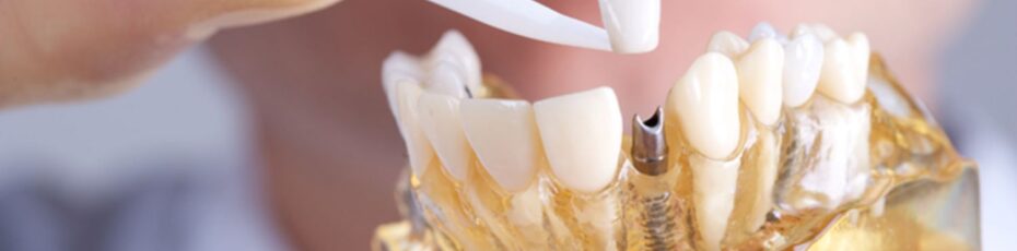 rebuild your smile with dental implants