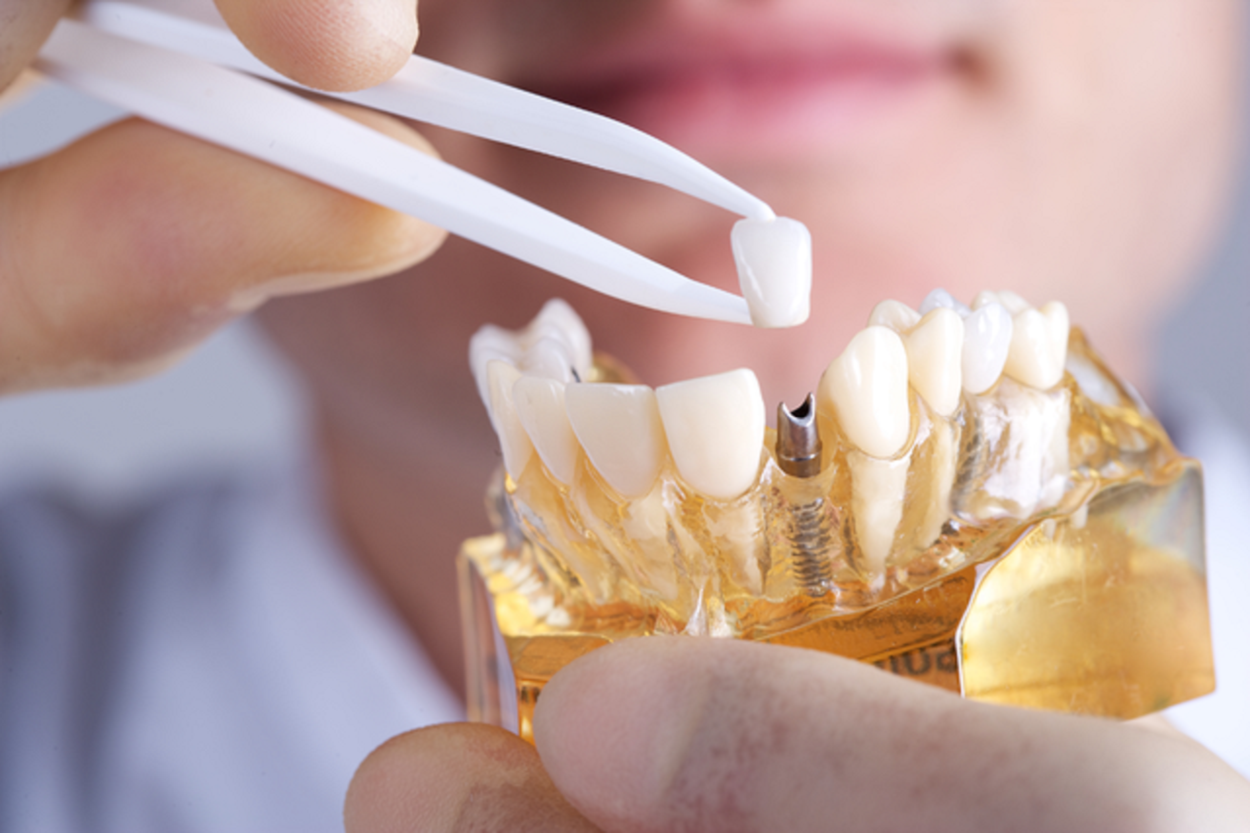rebuild your smile with dental implants