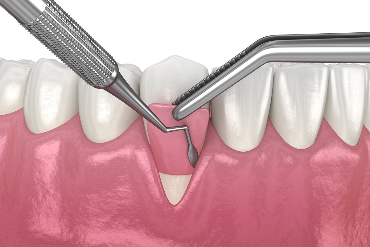 recovering from gum graft surgery tips for a smooth healing process