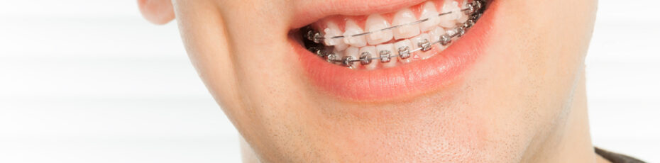 traditional braces and sports how to stay active and safe