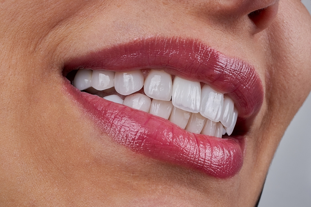 Dental Bonding: A Quick & Painless Way to Enhance Your Smile