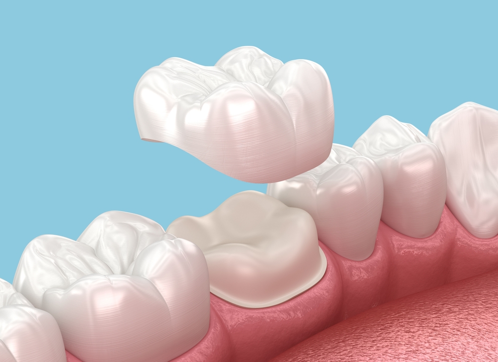 Understanding Dental Crowns and Bridges: What They Are and How They Work