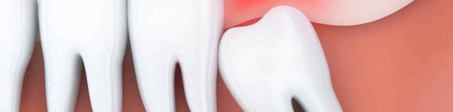 When Is the Right Time to Get Your Wisdom Teeth Removed?