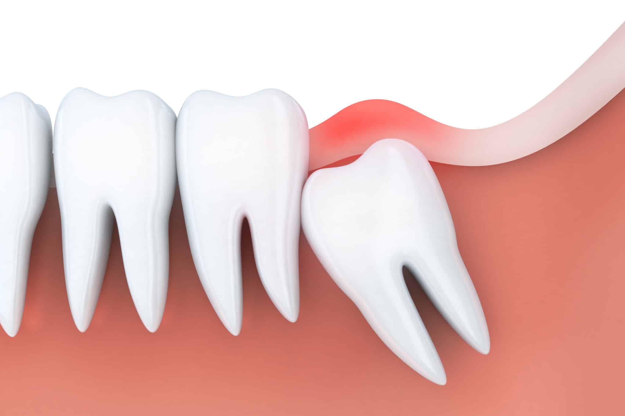 When Is the Right Time to Get Your Wisdom Teeth Removed?