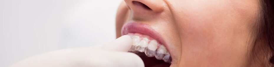 Can Adults Get Invisalign? Benefits Explained