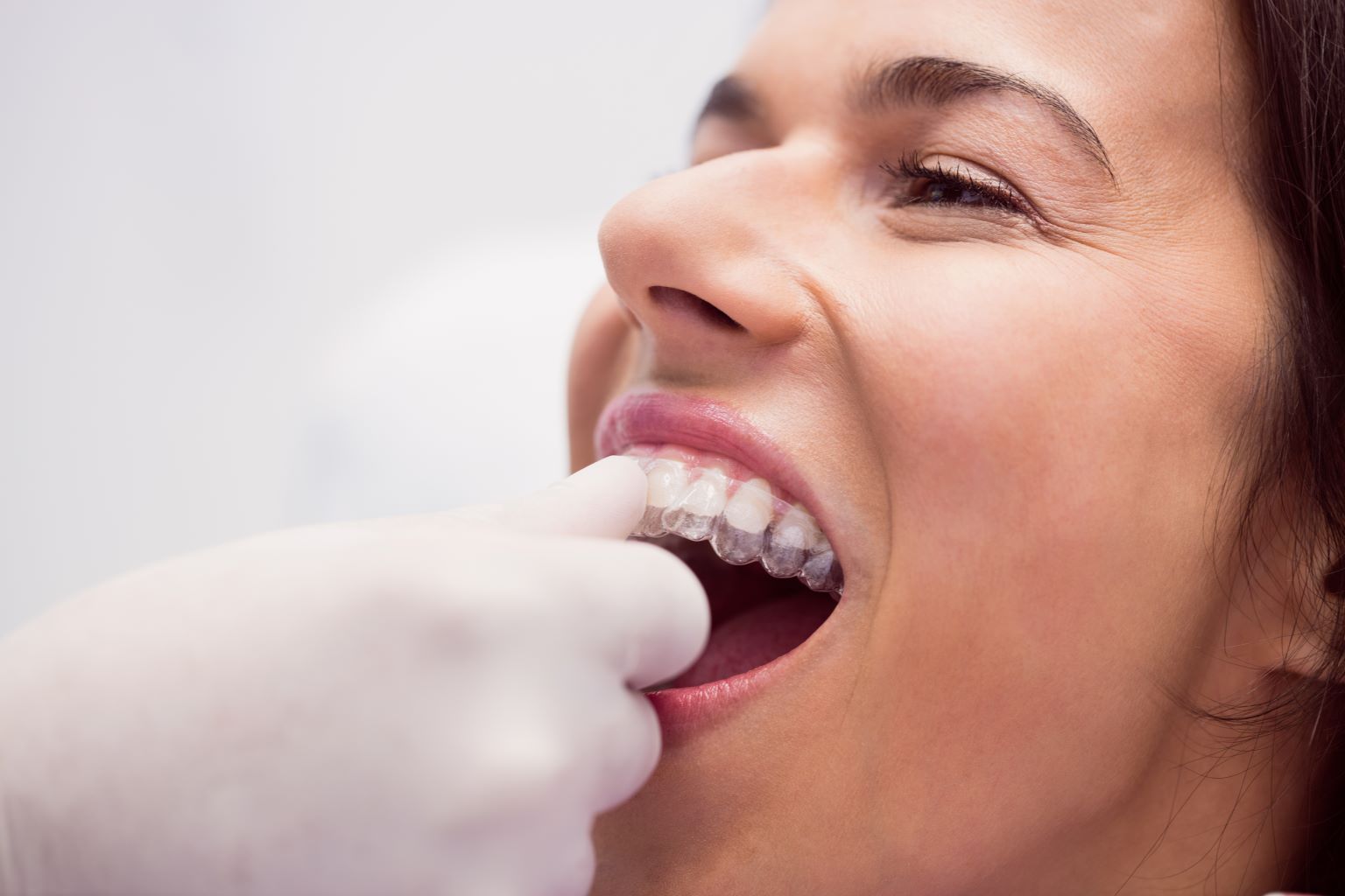 Can Adults Get Invisalign? Benefits Explained