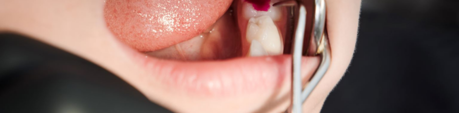 Gum Recession? Why Gum Grafting Matters