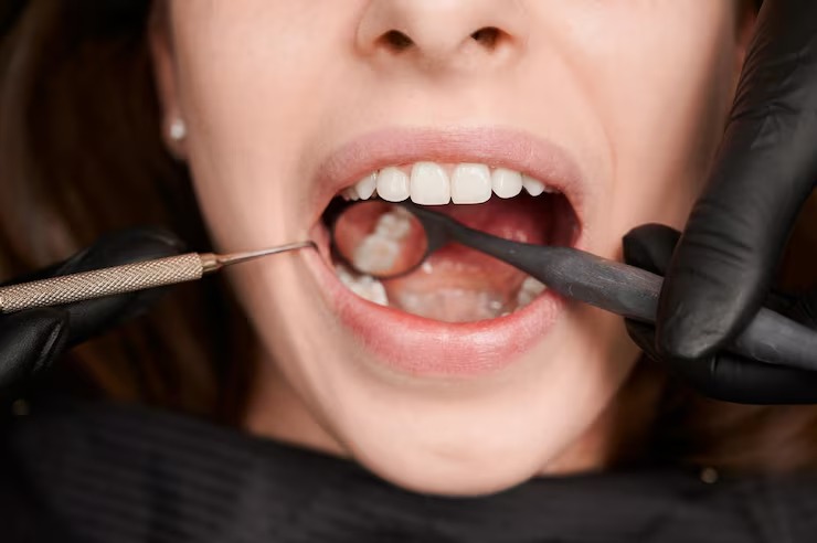 Sign you may need gum grafting dont ignore receding gums