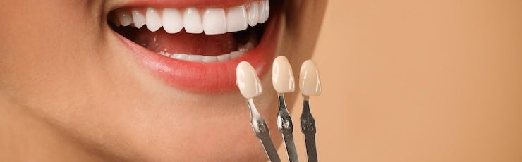 How porcelain veneers fix chipped teeth naturally