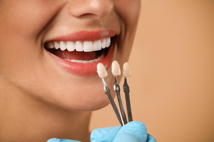 How porcelain veneers fix chipped teeth naturally